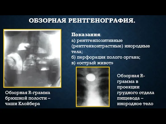 ОБЗОРНАЯ РЕНТГЕНОГРАФИЯ. Обзорная R-грамма брюшной полости – чаши Клойбера Обзорная