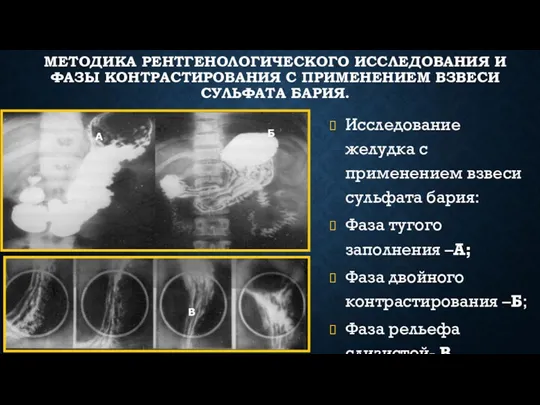 МЕТОДИКА РЕНТГЕНОЛОГИЧЕСКОГО ИССЛЕДОВАНИЯ И ФАЗЫ КОНТРАСТИРОВАНИЯ С ПРИМЕНЕНИЕМ ВЗВЕСИ СУЛЬФАТА