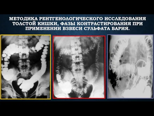 МЕТОДИКА РЕНТГЕНОЛОГИЧЕСКОГО ИССЛЕДОВАНИЯ ТОЛСТОЙ КИШКИ, ФАЗЫ КОНТРАСТИРОВАНИЯ ПРИ ПРИМЕНЕНИИ ВЗВЕСИ СУЛЬФАТА БАРИЯ.