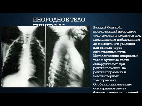 ИНОРОДНОЕ ТЕЛО ПИЩЕВОДА Каждый больной, проглотивший инородное тело, должен находиться