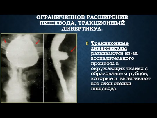 ОГРАНИЧЕННОЕ РАСШИРЕНИЕ ПИЩЕВОДА, ТРАКЦИОННЫЙ ДИВЕРТИКУЛ. Тракционные дивертикулы развиваются из-за воспалительного