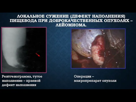 ЛОКАЛЬНОЕ СУЖЕНИЕ (ДЕФЕКТ НАПОЛНЕНИЯ) ПИЩЕВОДА ПРИ ДОБРОКАЧЕСТВЕННЫХ ОПУХОЛЯХ – ЛЕЙОМИОМА.