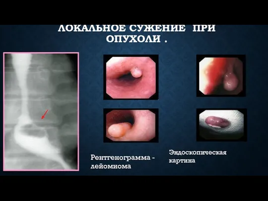 ЛОКАЛЬНОЕ СУЖЕНИЕ ПРИ ОПУХОЛИ . Эндоскопическая картина Рентгенограмма - лейомиома