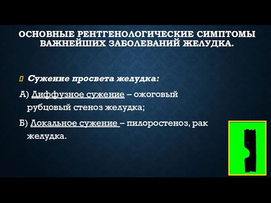 ОСНОВНЫЕ РЕНТГЕНОЛОГИЧЕСКИЕ СИМПТОМЫ ВАЖНЕЙШИХ ЗАБОЛЕВАНИЙ ЖЕЛУДКА. Сужение просвета желудка: А)