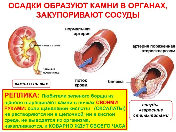 камни в почках сосуды, «заросшие сталактитами ОСАДКИ ОБРАЗУЮТ КАМНИ В