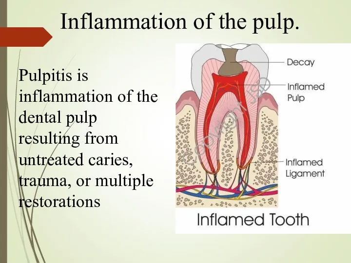 Inflammation of the pulp. Pulpitis is inflammation of the dental