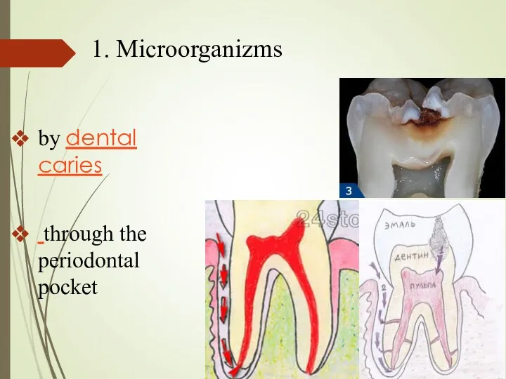 by dental caries through the periodontal pocket 1. Microorganizms