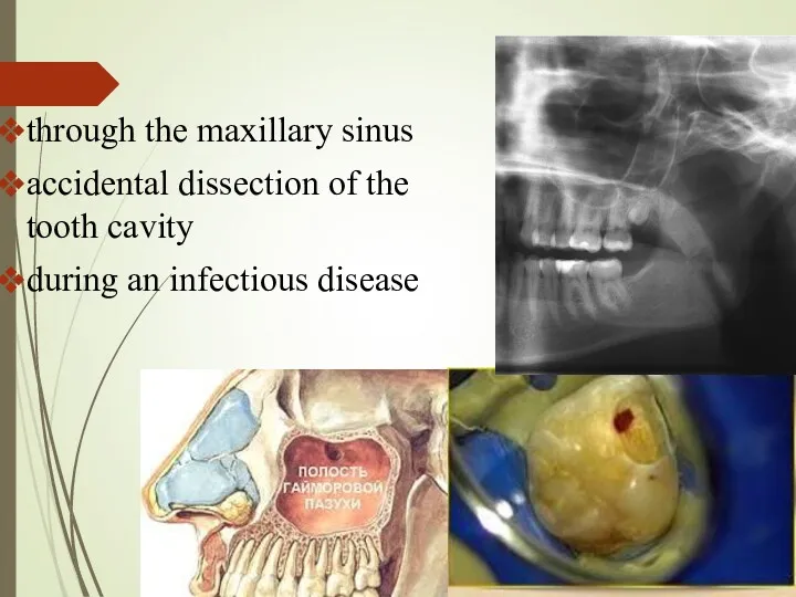 through the maxillary sinus accidental dissection of the tooth cavity during an infectious disease