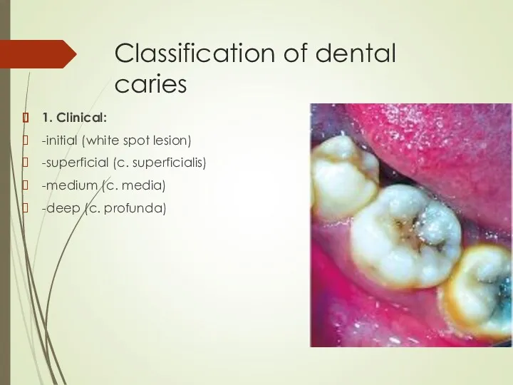 Classification of dental caries 1. Clinical: -initial (white spot lesion)