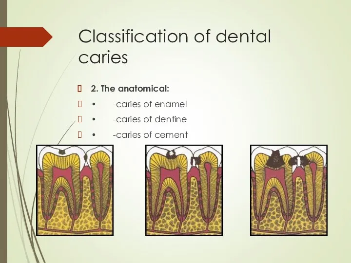 Classification of dental caries 2. The anatomical: • -caries of