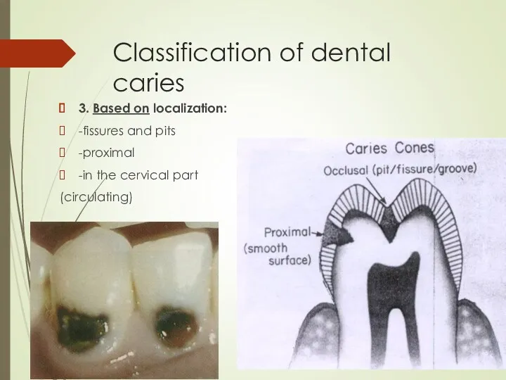 Classification of dental caries 3. Based on localization: -fissures and