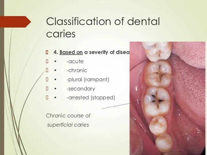 Classification of dental caries 4. Based on a severity of