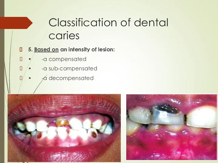 Classification of dental caries 5. Based on an intensity of