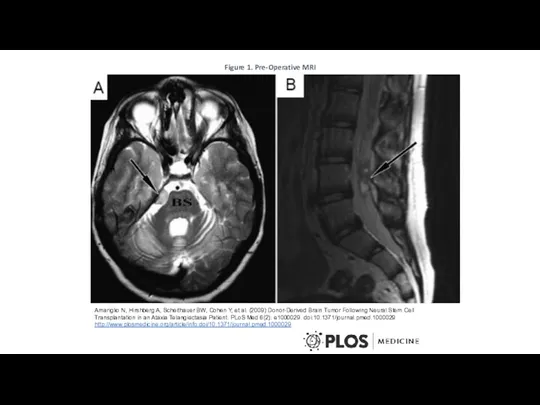 Figure 1. Pre-Operative MRI Amariglio N, Hirshberg A, Scheithauer BW,