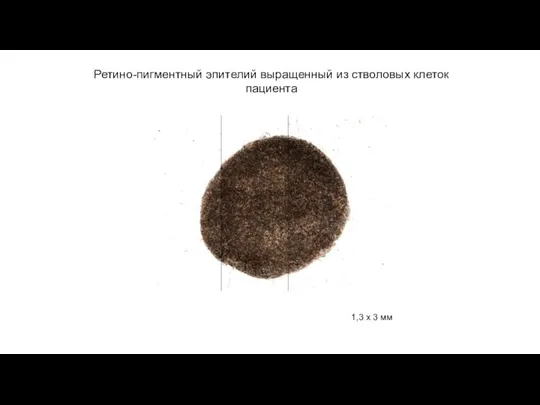 Ретино-пигментный эпителий выращенный из стволовых клеток пациента 1,3 х 3 мм
