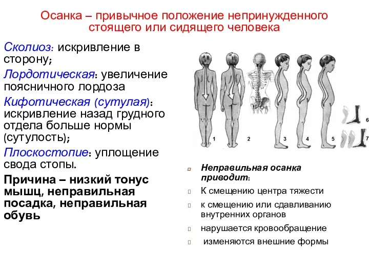 Сколиоз: искривление в сторону; Лордотическая: увеличение поясничного лордоза Кифотическая (сутулая):