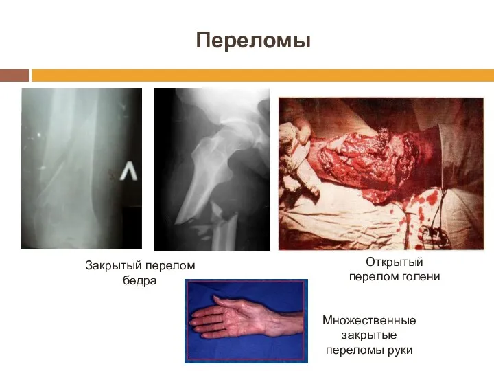 Переломы Закрытый перелом бедра Открытый перелом голени Множественные закрытые переломы руки