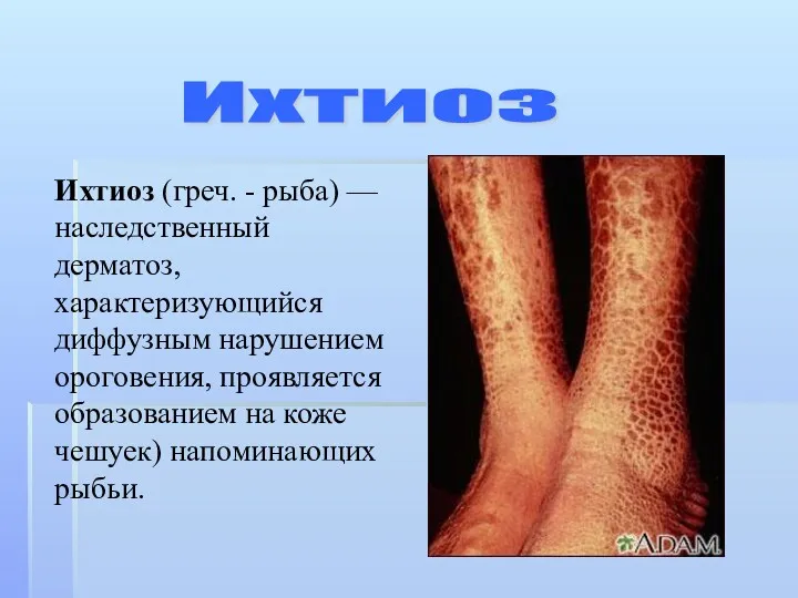 Ихтиоз (греч. - рыба) — наследственный дерматоз, характеризующийся диффузным нарушением