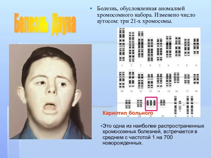 Болезнь, обусловленная аномалией хромосомного набора. Изменено число аутосом: три 21-х