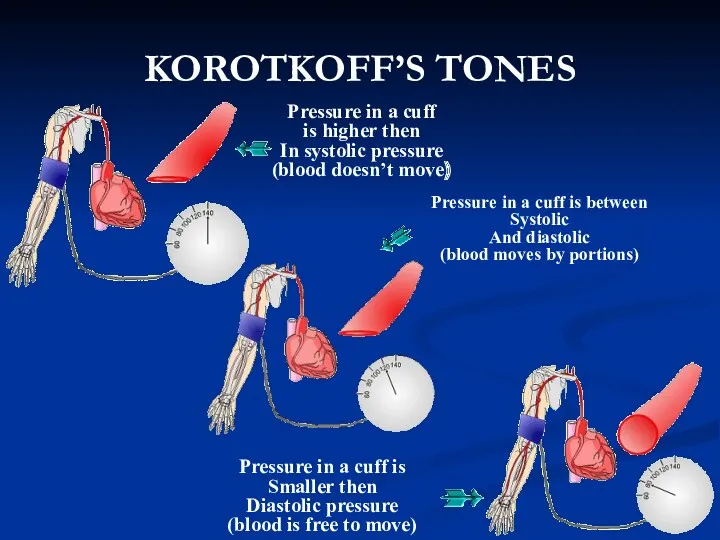 KOROTKOFF’S TONES Pressure in a cuff is between Systolic And