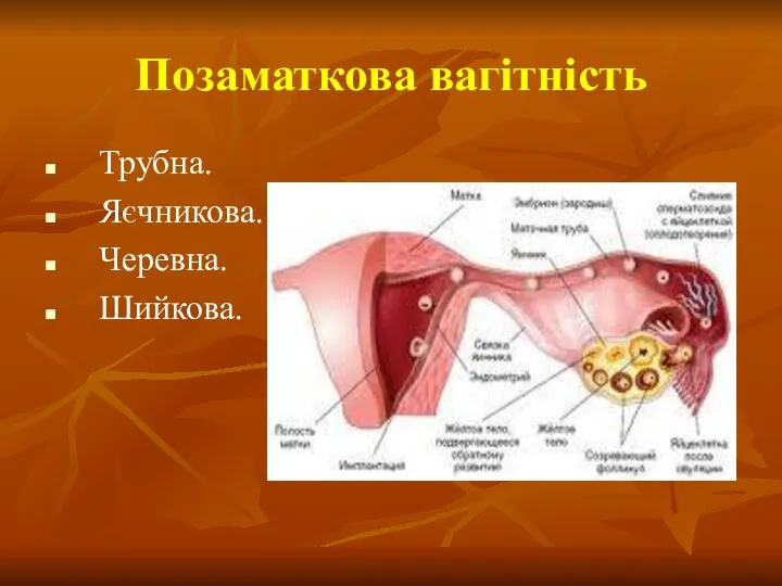 Позаматкова вагітність Трубна. Яєчникова. Черевна. Шийкова.