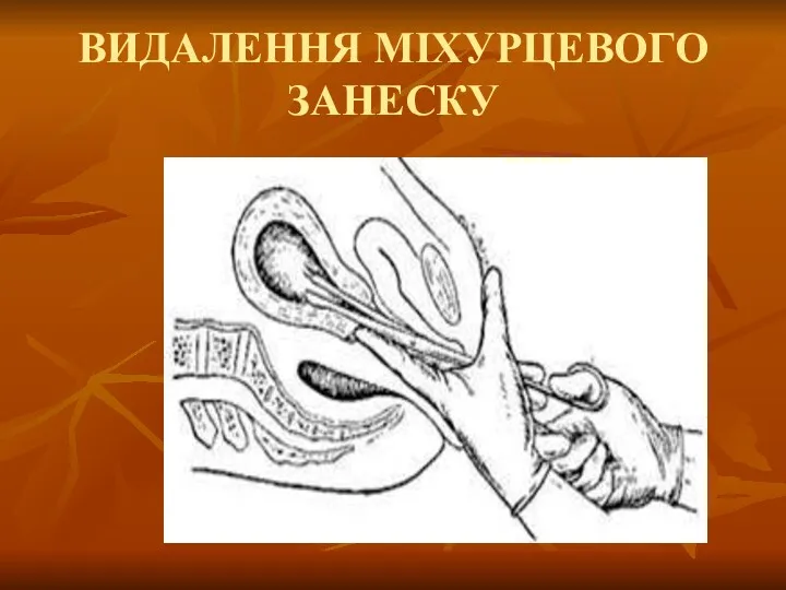 ВИДАЛЕННЯ МІХУРЦЕВОГО ЗАНЕСКУ