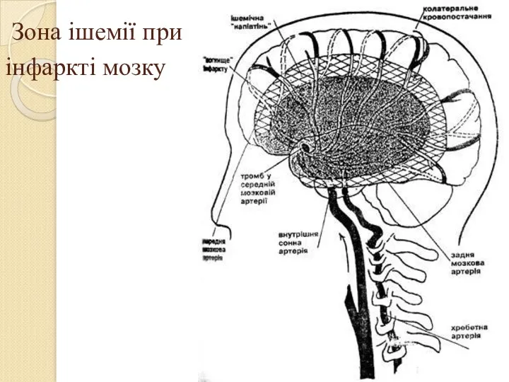 Зона ішемії при інфаркті мозку