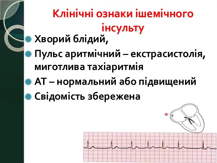 Клінічні ознаки ішемічного інсульту Хворий блідий, Пульс аритмічний – екстрасистолія,