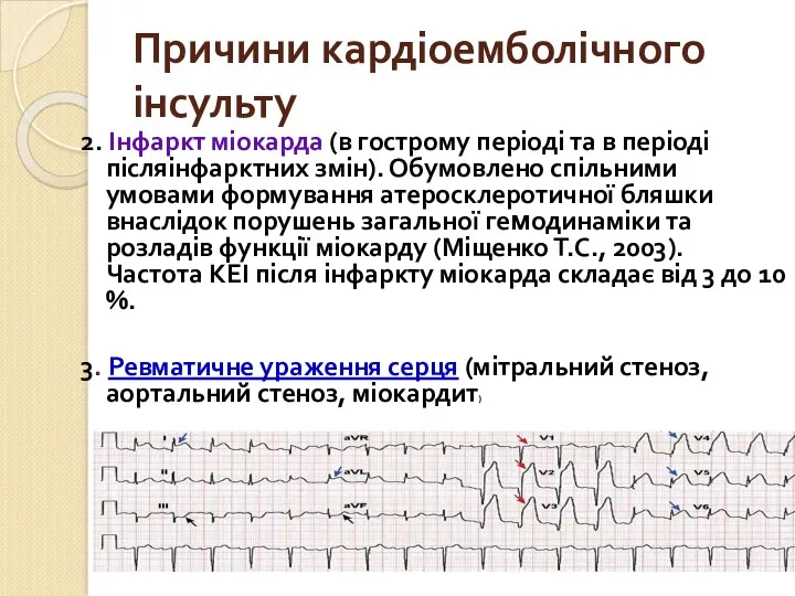 Причини кардіоемболічного інсульту 2. Інфаркт міокарда (в гострому періоді та