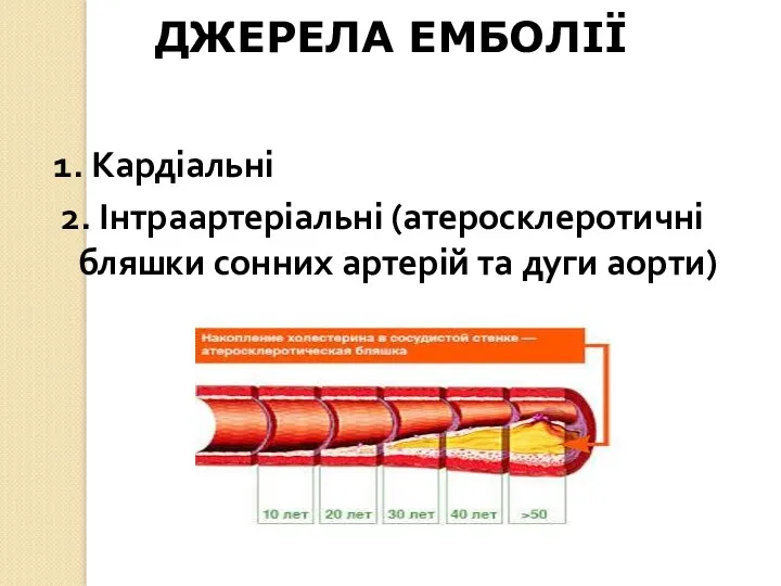 ДЖЕРЕЛА ЕМБОЛІЇ 1. Кардіальні 2. Інтраартеріальні (атеросклеротичні бляшки сонних артерій та дуги аорти)