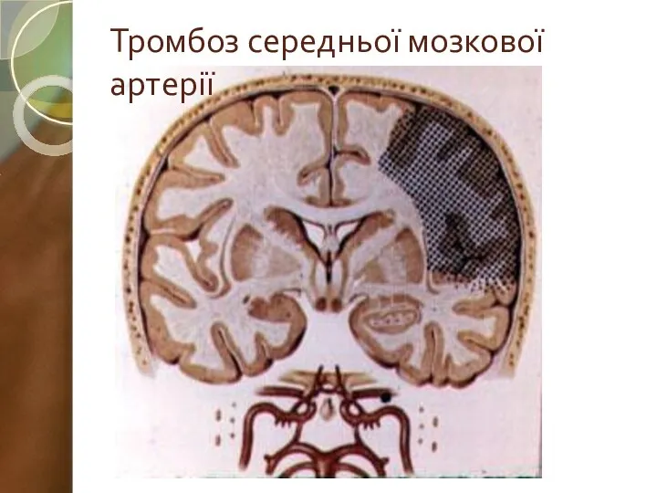 Тромбоз середньої мозкової артерії