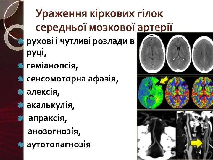 Ураження кіркових гілок середньої мозкової артерії рухові і чутливі розлади