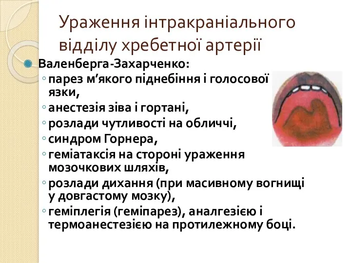 Ураження інтракраніального відділу хребетної артерії Валенберга-Захарченко: парез м’якого піднебіння і