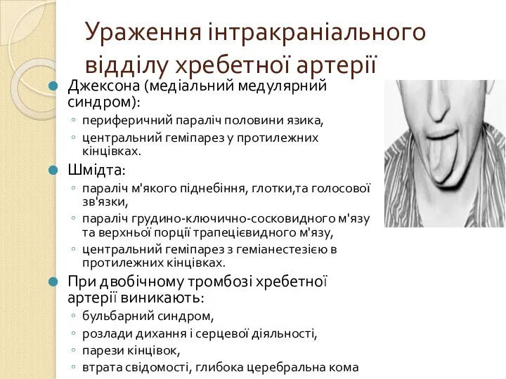 Ураження інтракраніального відділу хребетної артерії Джексона (медіальний медулярний синдром): периферичний