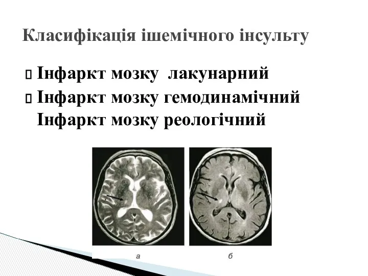 Класифікація ішемічного інсульту Інфаркт мозку лакунарний Інфаркт мозку гемодинамічний Інфаркт мозку реологічний