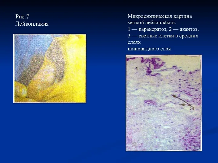 Микроскопическая картина мягкой лейкоплакии. 1 — паракератоз, 2 — акантоз, 3 — светлые
