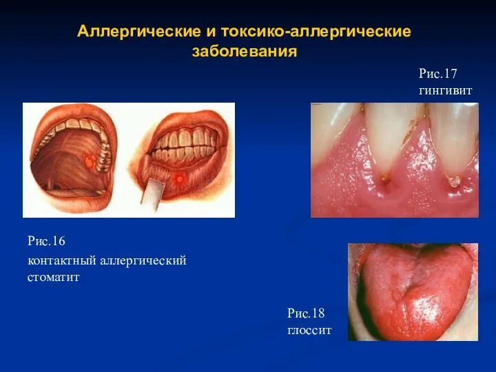 Рис.16 контактный аллергический стоматит Рис.17 гингивит Рис.18 глоссит Аллергические и токсико-аллергические заболевания