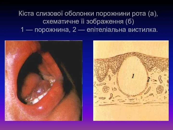 Кіста слизової оболонки порожнини рота (а), схематичне їі зоб­раження (б)