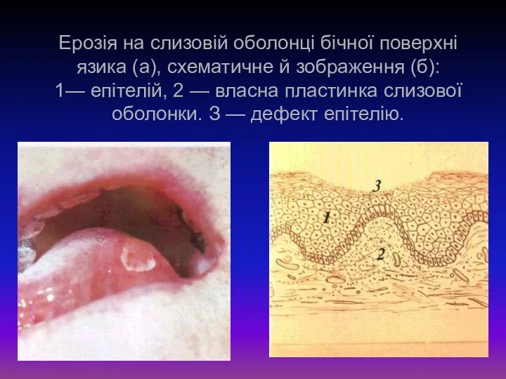 Ерозія на слизовій оболонці бічної поверхні язика (а), схематичне й