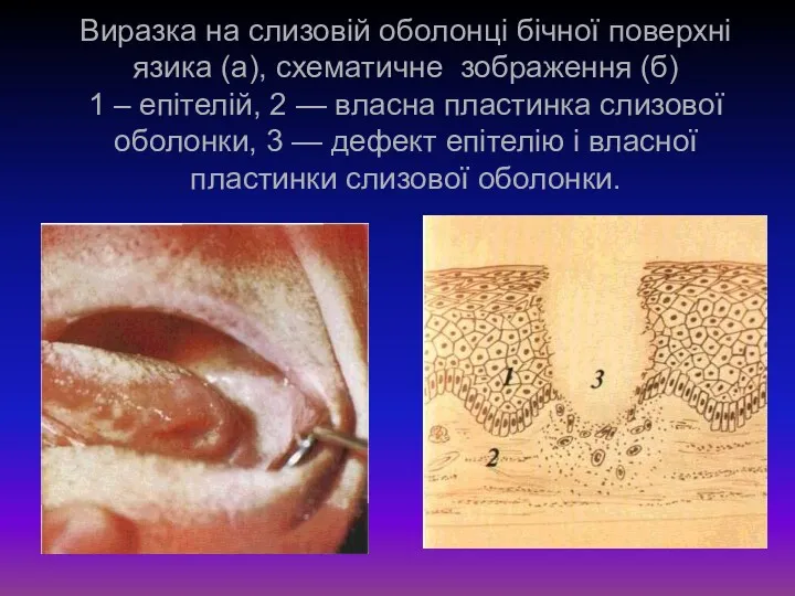Виразка на слизовій оболонці бічної поверхні язика (а), схематичне зображення