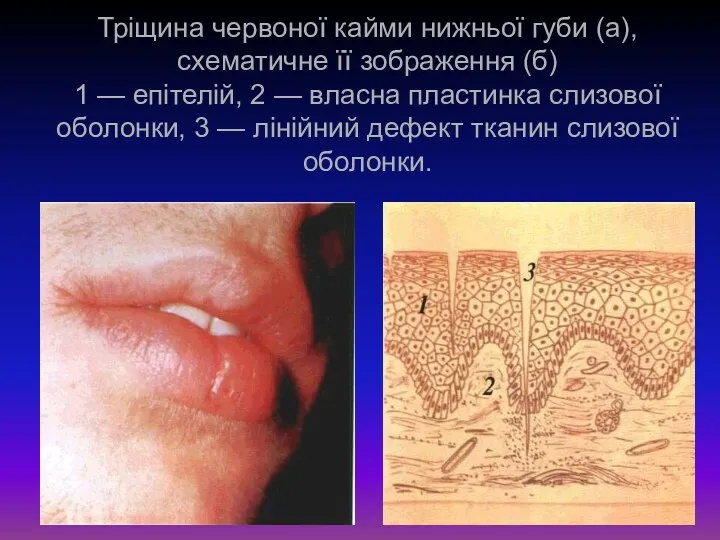 Тріщина червоної кайми нижньої губи (а), схематичне її зображення (б)