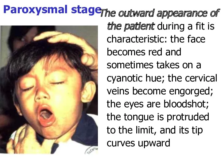 Paroxysmal stage The outward appearance of the patient during a fit is characteristic: