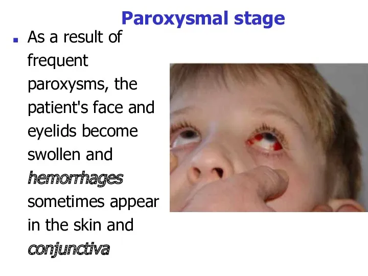 Paroxysmal stage As a result of frequent paroxysms, the patient's face and eyelids