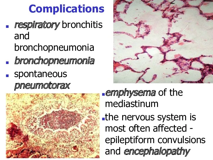 Complications respiratory bronchitis and bronchopneumonia bronchopneumonia spontaneous pneumotorax emphysema of the mediastinum the