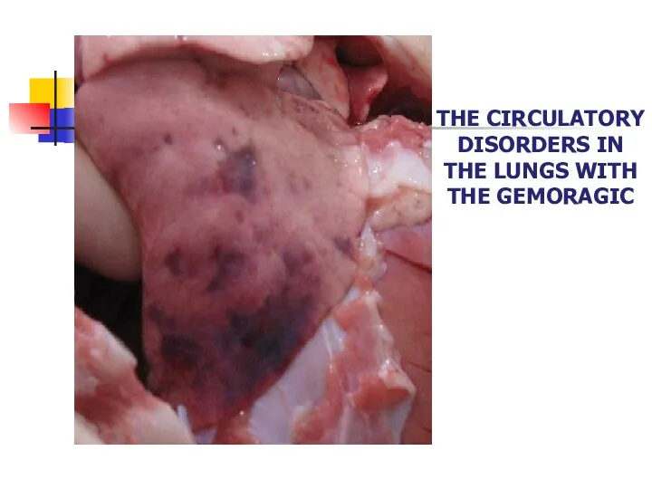 THE CIRCULATORY DISORDERS IN THE LUNGS WITH THE GEMORAGIC