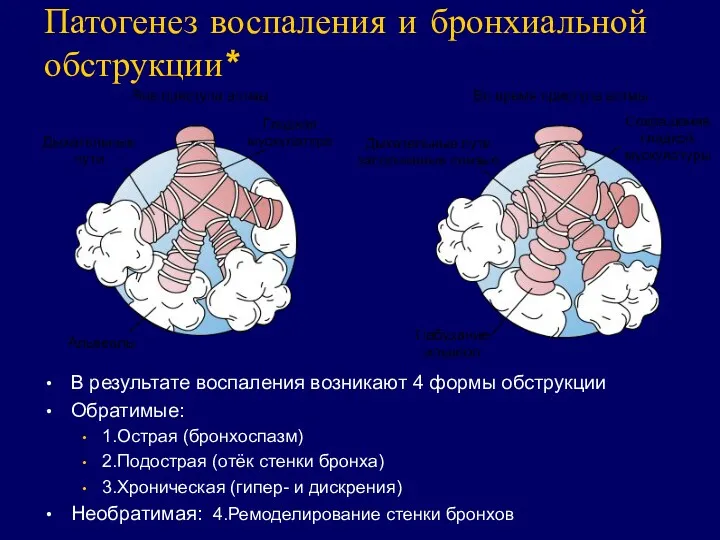 Патогенез воспаления и бронхиальной обструкции* В результате воспаления возникают 4