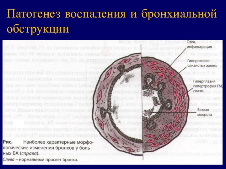 Патогенез воспаления и бронхиальной обструкции