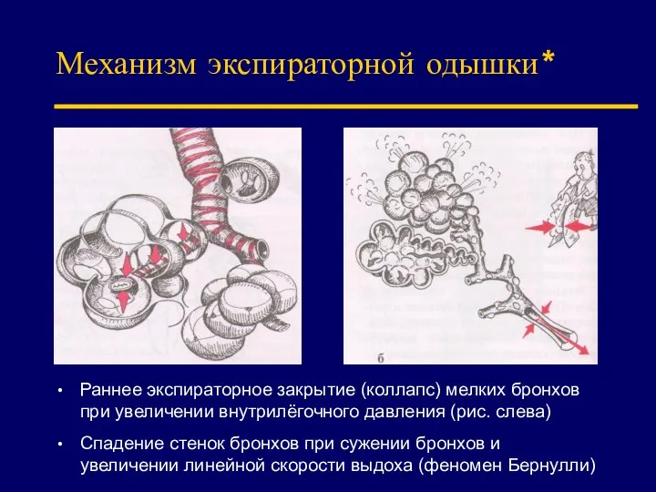 Механизм экспираторной одышки* Раннее экспираторное закрытие (коллапс) мелких бронхов при