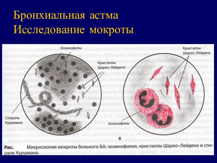 Бронхиальная астма Исследование мокроты