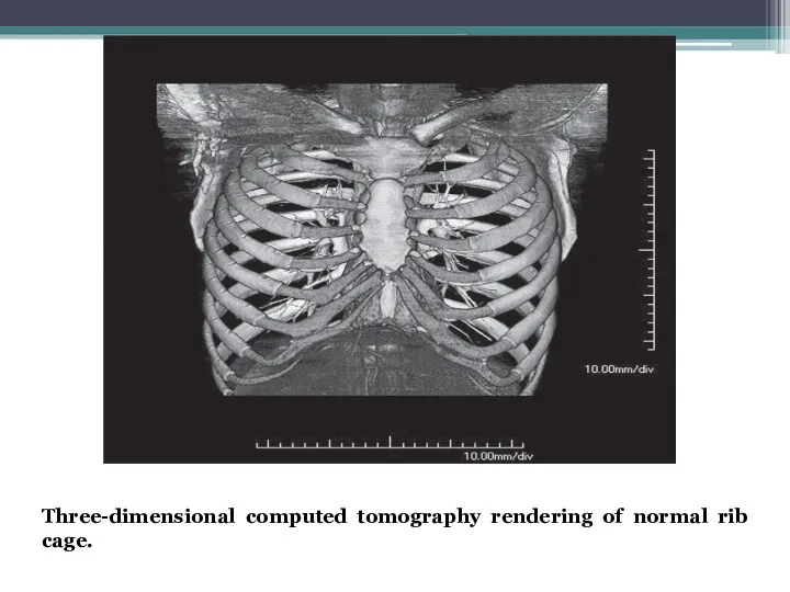 Three-dimensional computed tomography rendering of normal rib cage.